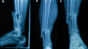 Хирургический 3D-принтер: создан клеевой пистолет для печати костей прямо в операционной